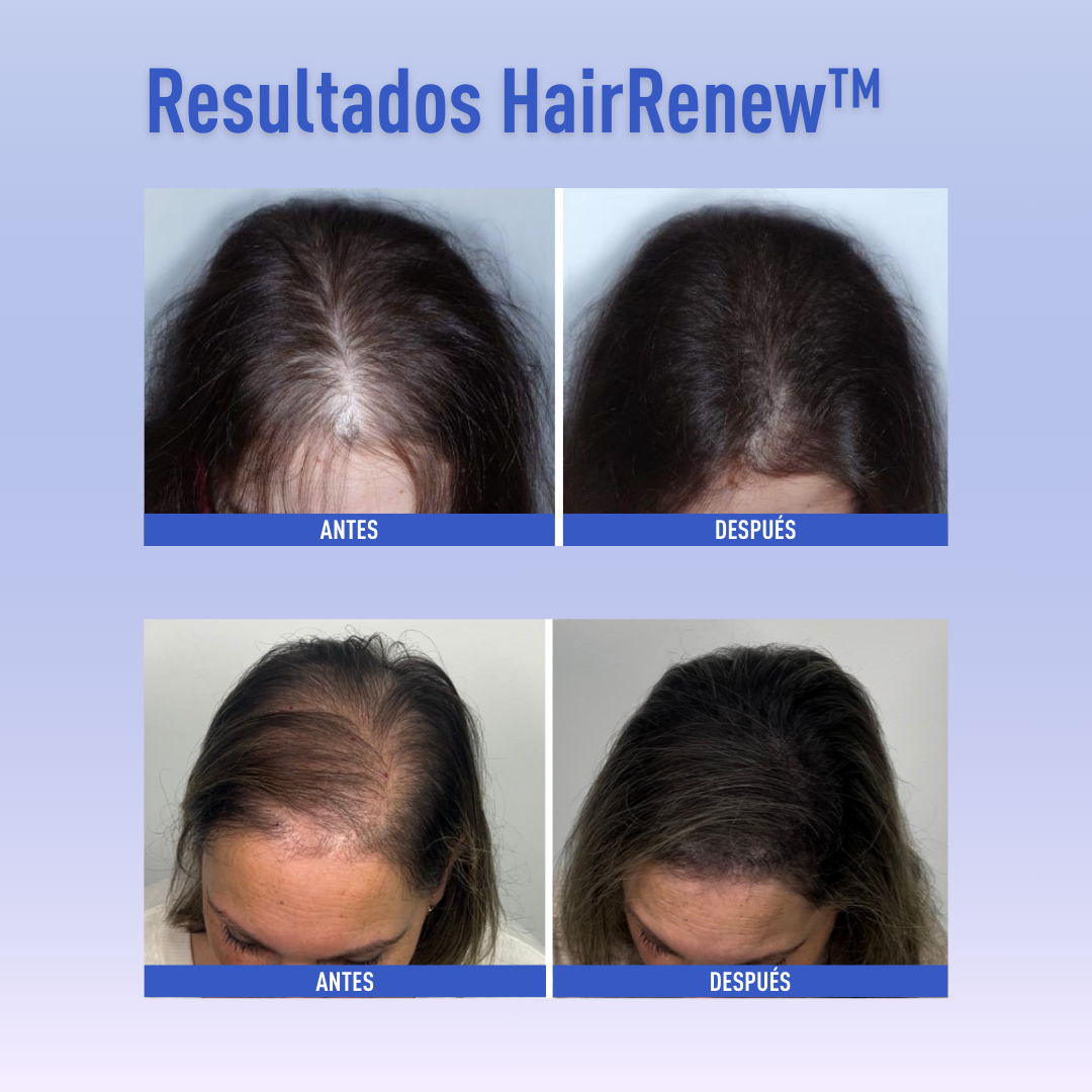 HairRenew™ – Crecimiento capilar fácil y natural