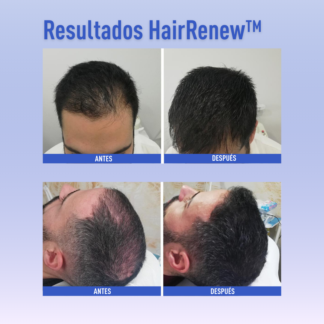 HairRenew™ – Crecimiento capilar fácil y natural